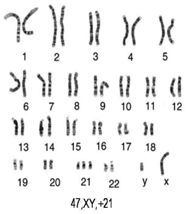 Trisomy 21 karyotype